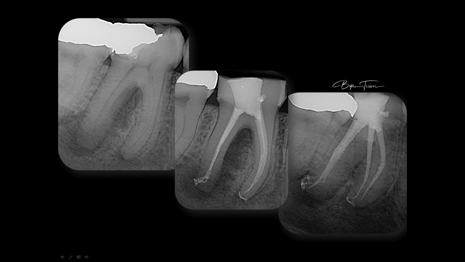 Broken Instrument Removal - Case 6